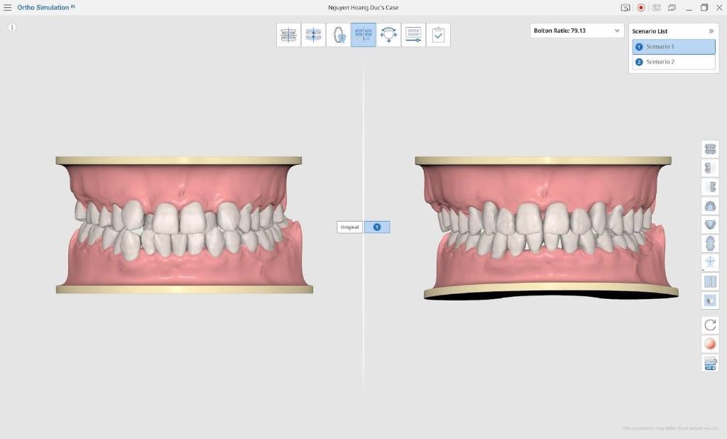 Mô phỏng chỉnh nha 3D Ortho Simulation
